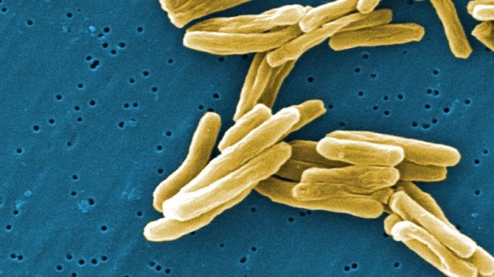 Seattle cancer patients possibly exposed to tuberculosis